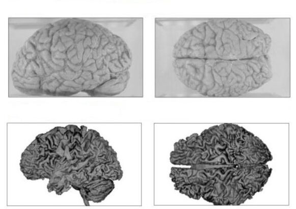 Мозъкът на здрав човек (отгоре) и мозъкът на алкохолик с необратими последствия (отдолу)